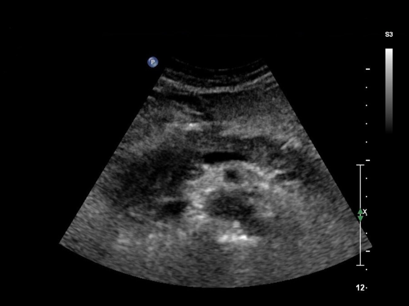 Enlarged hypoechoic pancreatic head