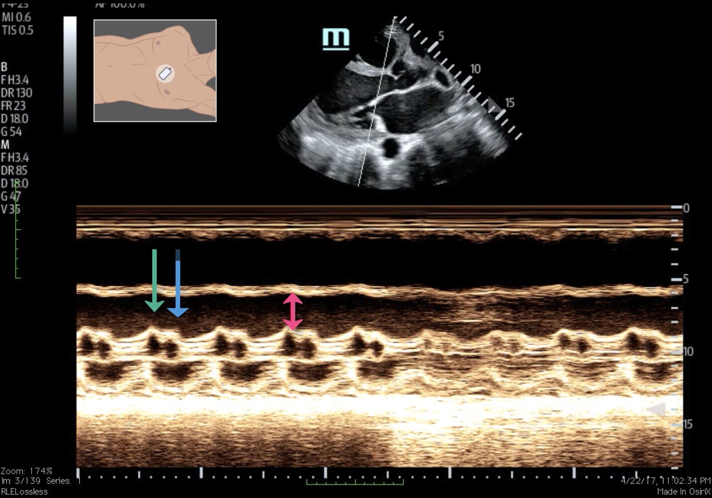 Echocardiography of systolic heart failure