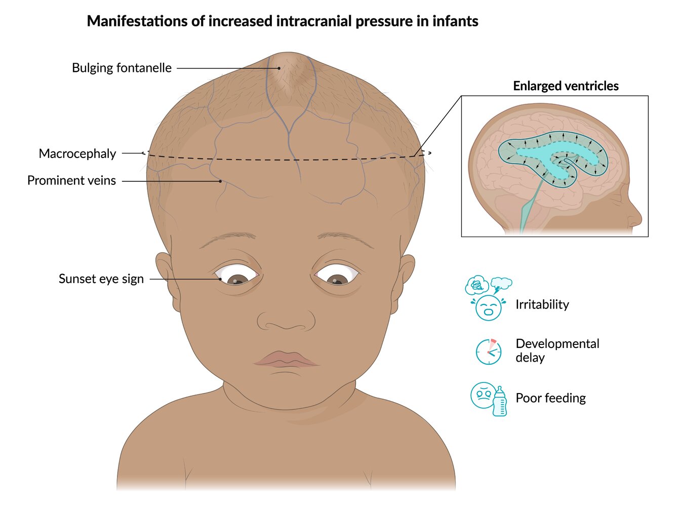 Manifestations of increased intracranial pressure in infants