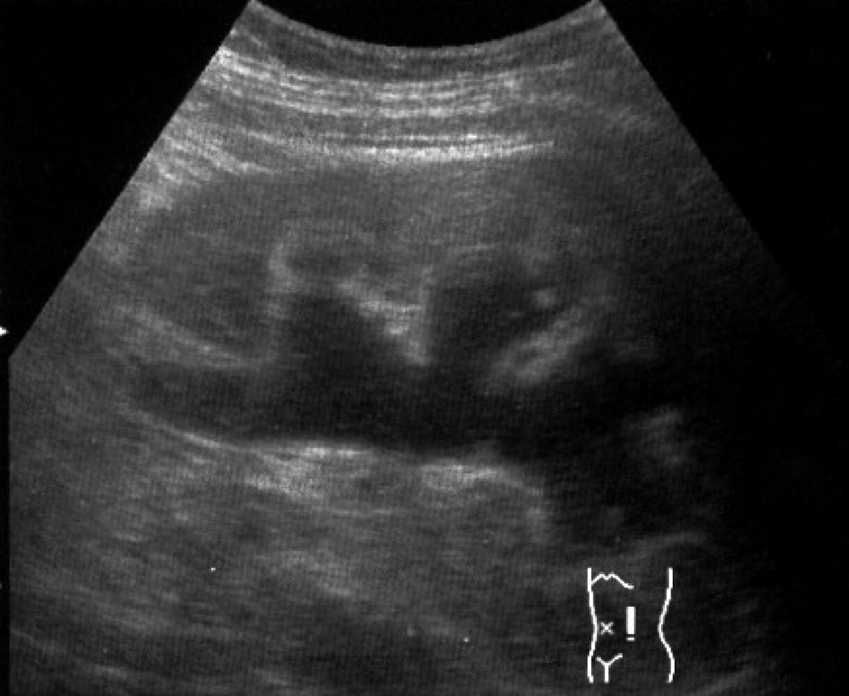 Hydronephrosis