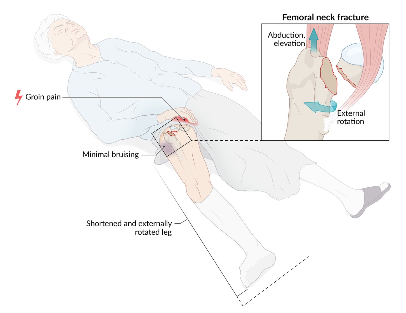 Clinical presentation of femoral neck fracture