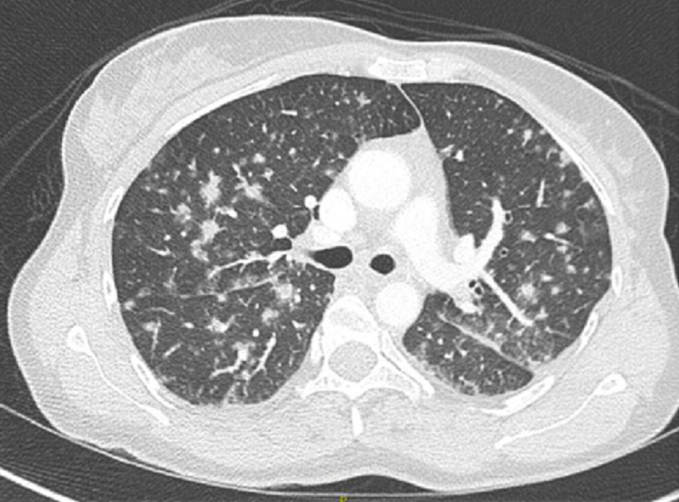 Multiple pulmonary nodules