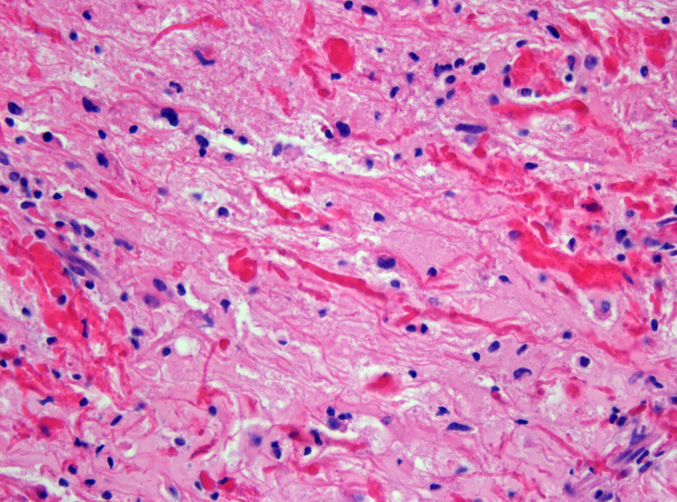 Rosenthal fibers