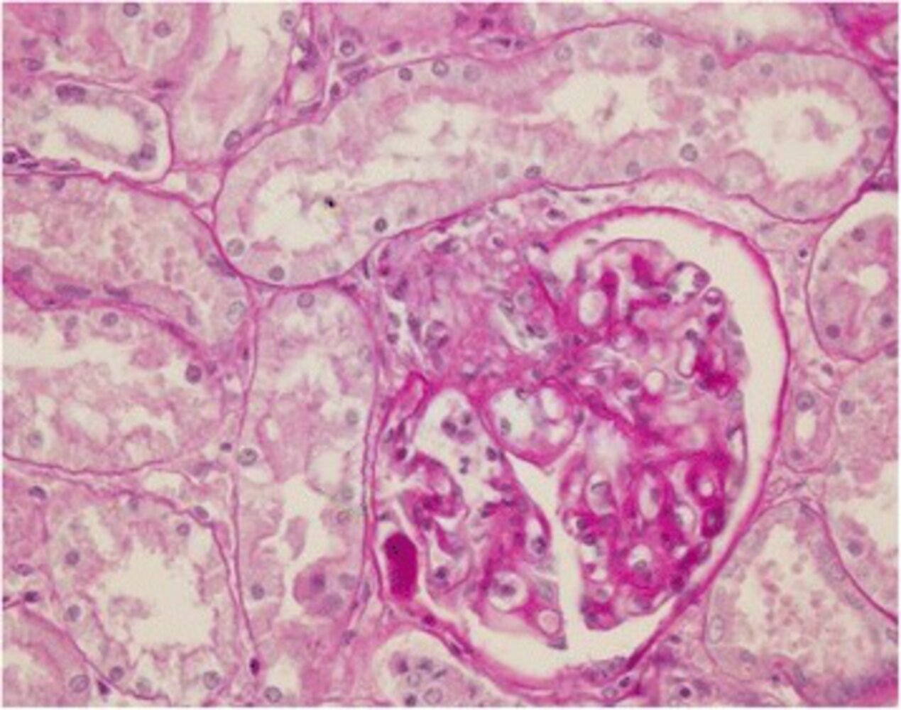 Tram-track appearance in membranoproliferative glomerulonephritis
