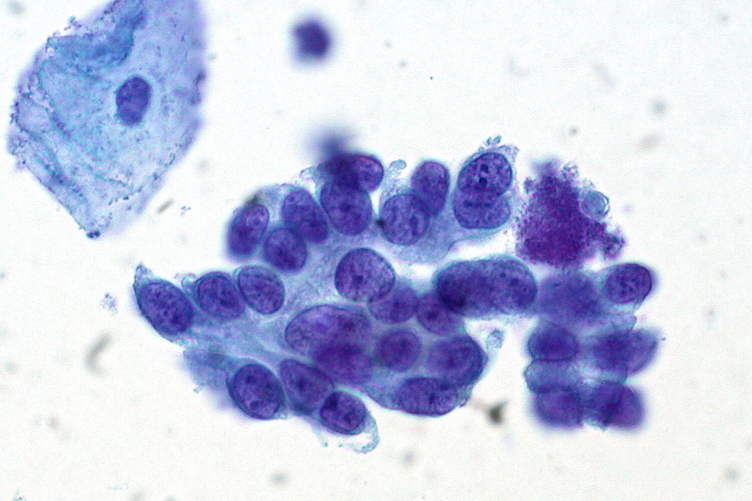Adenocarcinoma in situ (AIS) of the cervix