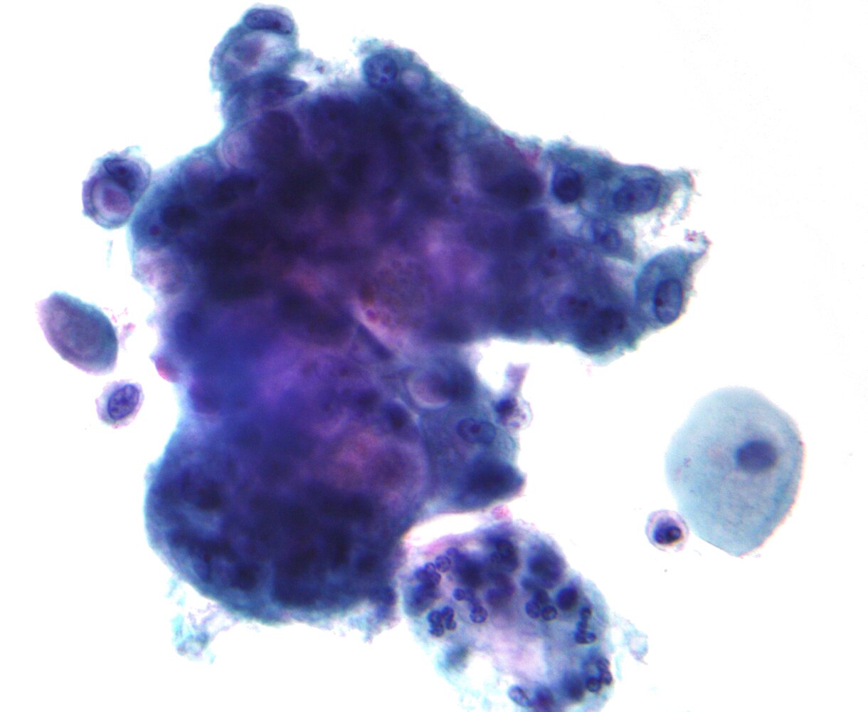 Endocervical Adenocarcinoma