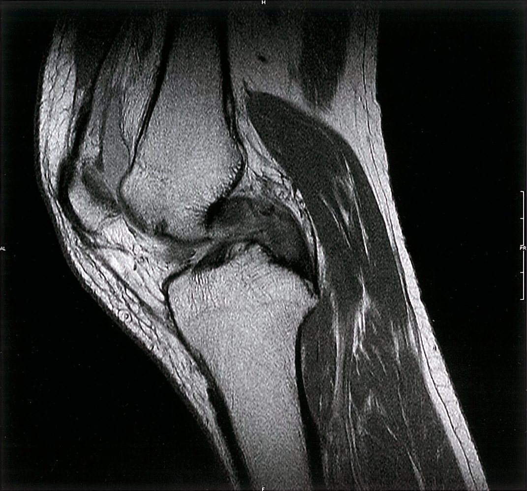 Posterior cruciate ligament tear