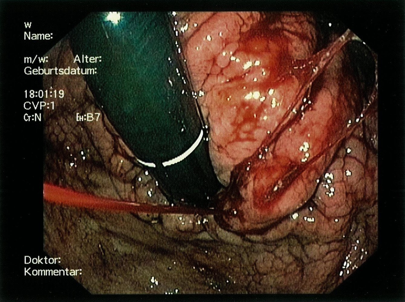 Fundal variceal hemorrhage