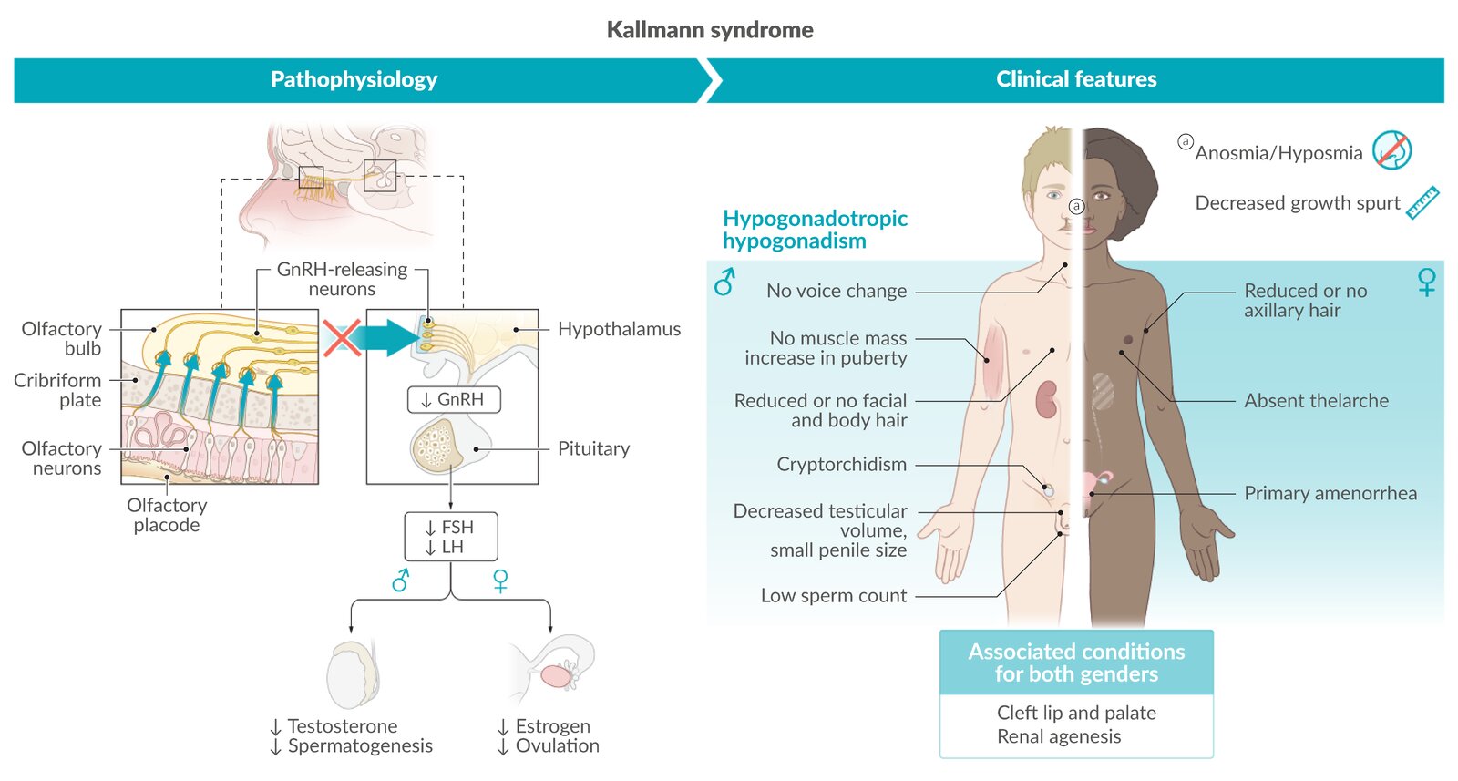 Kallmann syndrome