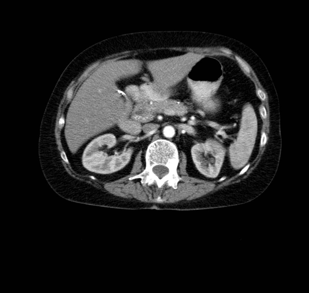 Pancreatic calcifications in chronic pancreatitis