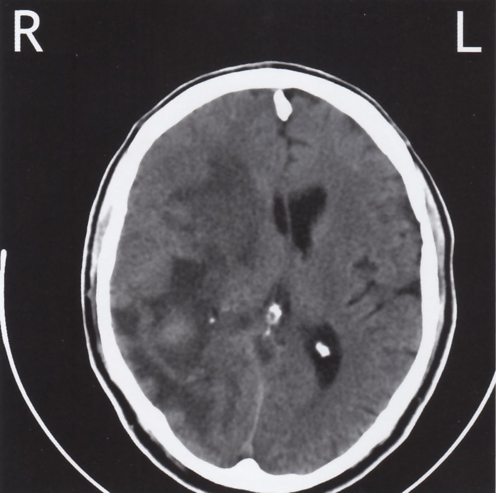 Mass effect from glioblastoma multiforme (WHO grade IV astrocytoma)