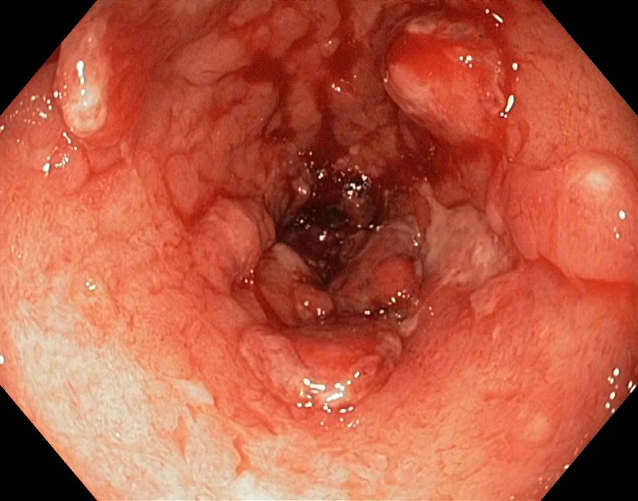 Active ulcerative colitis
