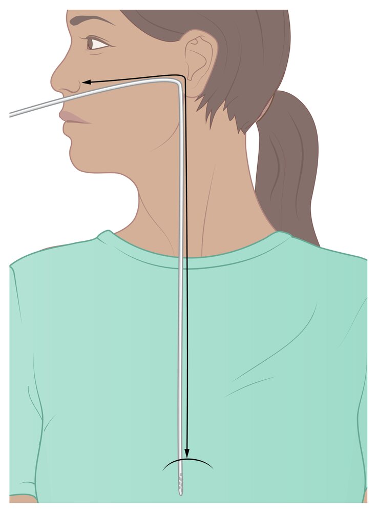 Insertion depth for nasogastric tube placement