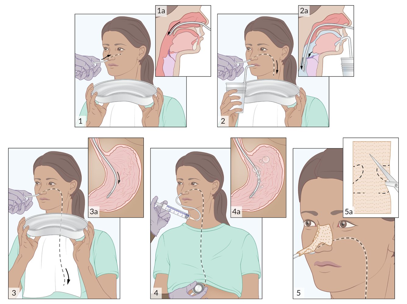 Nasogastric tube placement