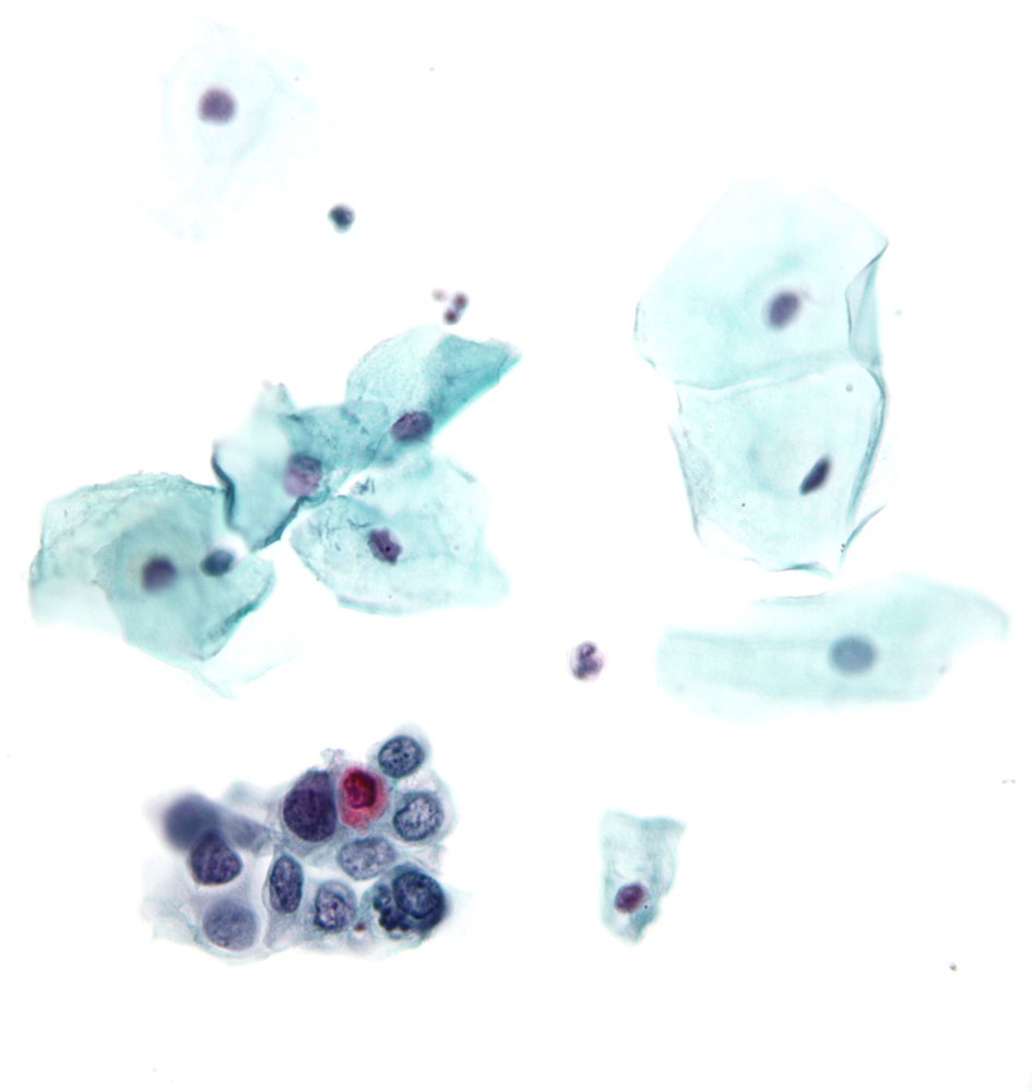 Papanicolaou test showing HSIL