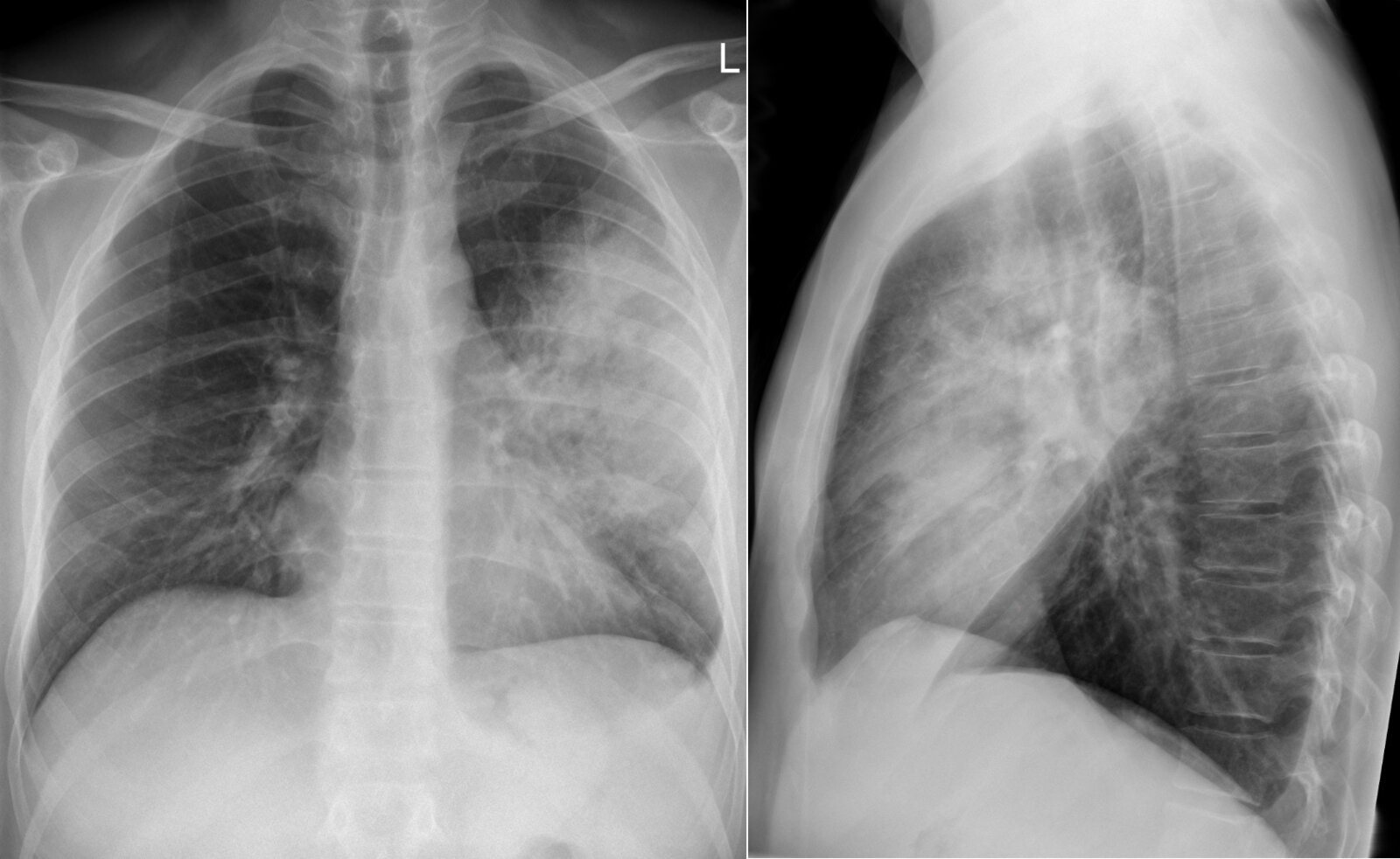 Lobar pneumonia with parapneumonic effusion