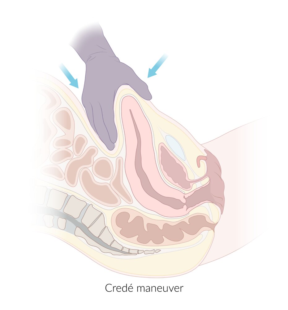 Credé maneuver