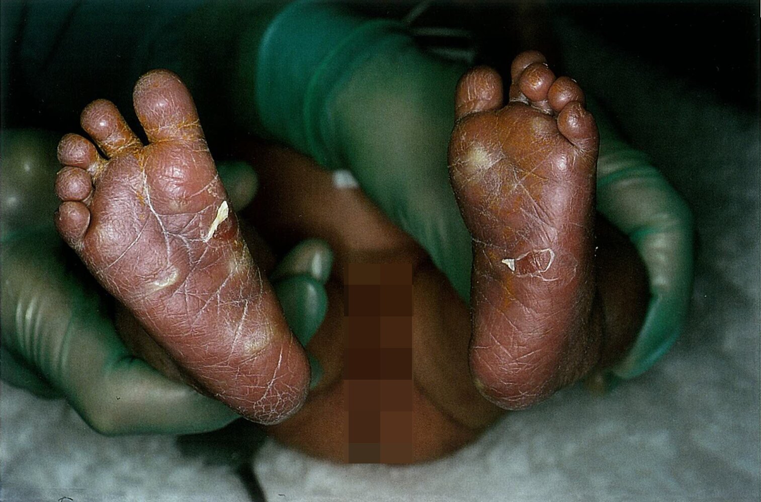 Skin alterations in congenital syphilis