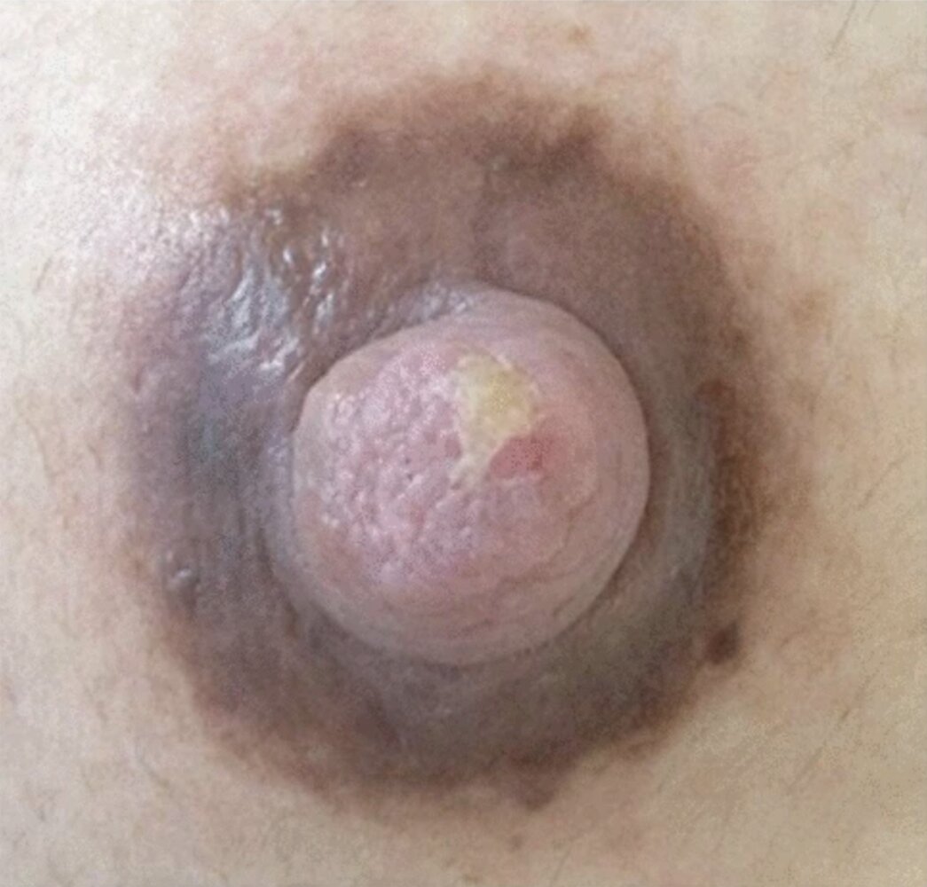 Nipple injury after breastfeeding