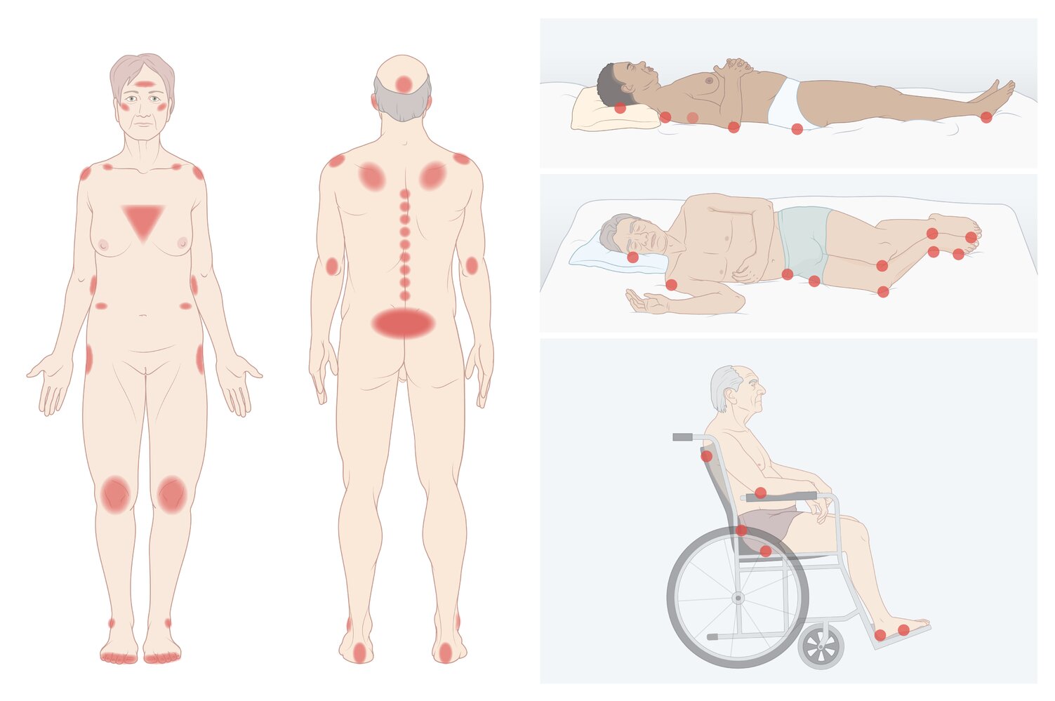 Typical locations of pressure ulcers (decubitus ulcers)