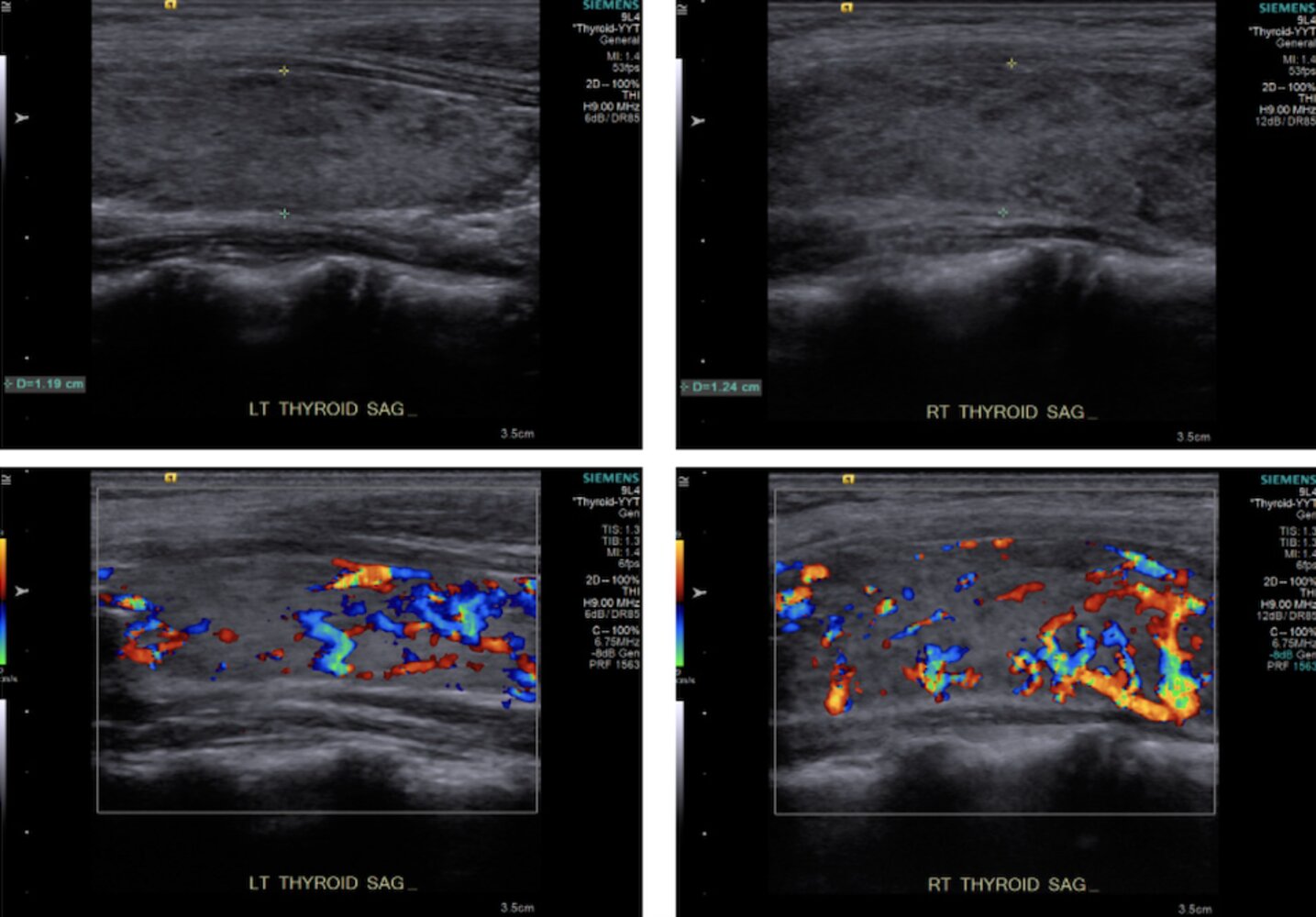 Thyroid gland in Graves disease