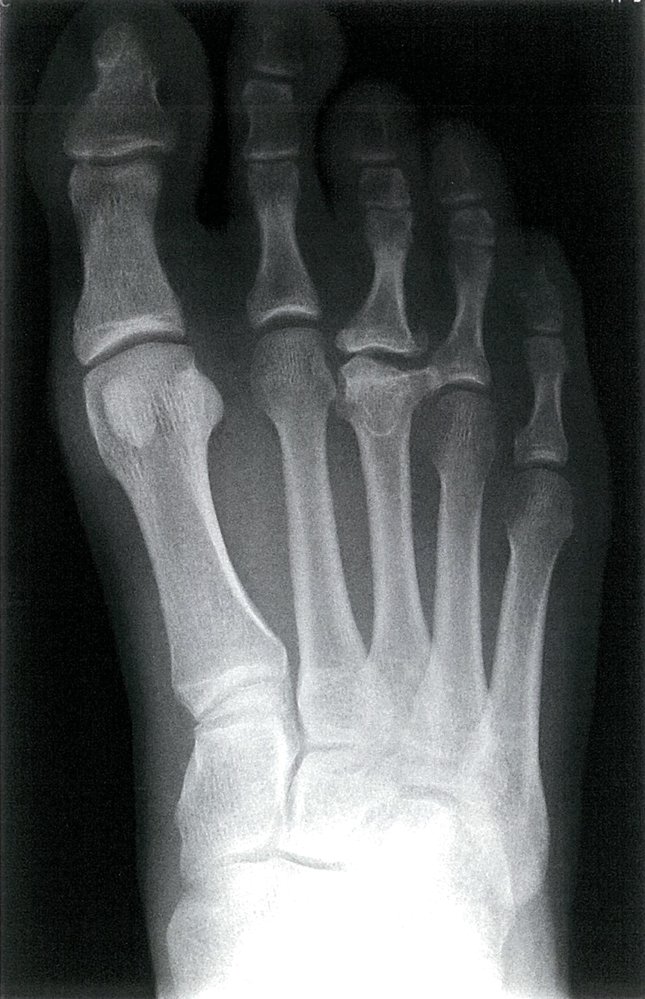 Freiberg disease