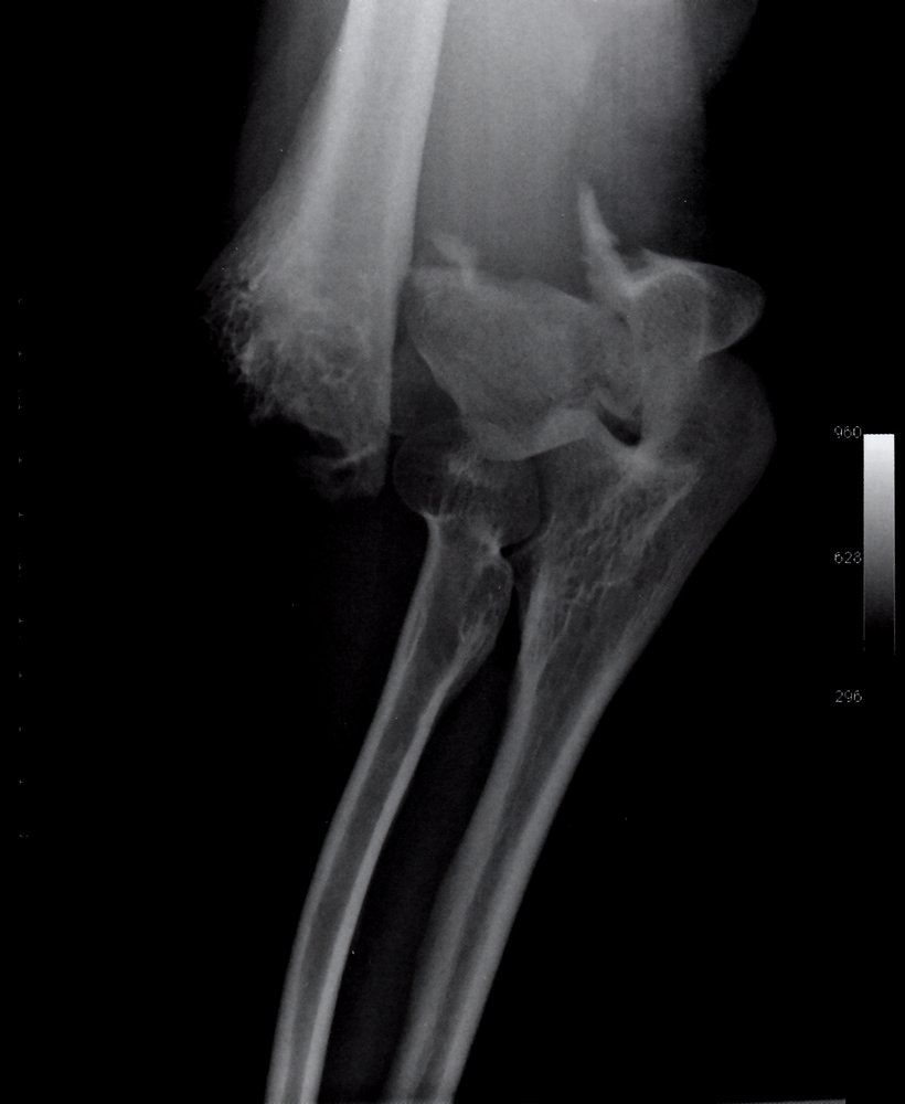 Distal humerus fracture