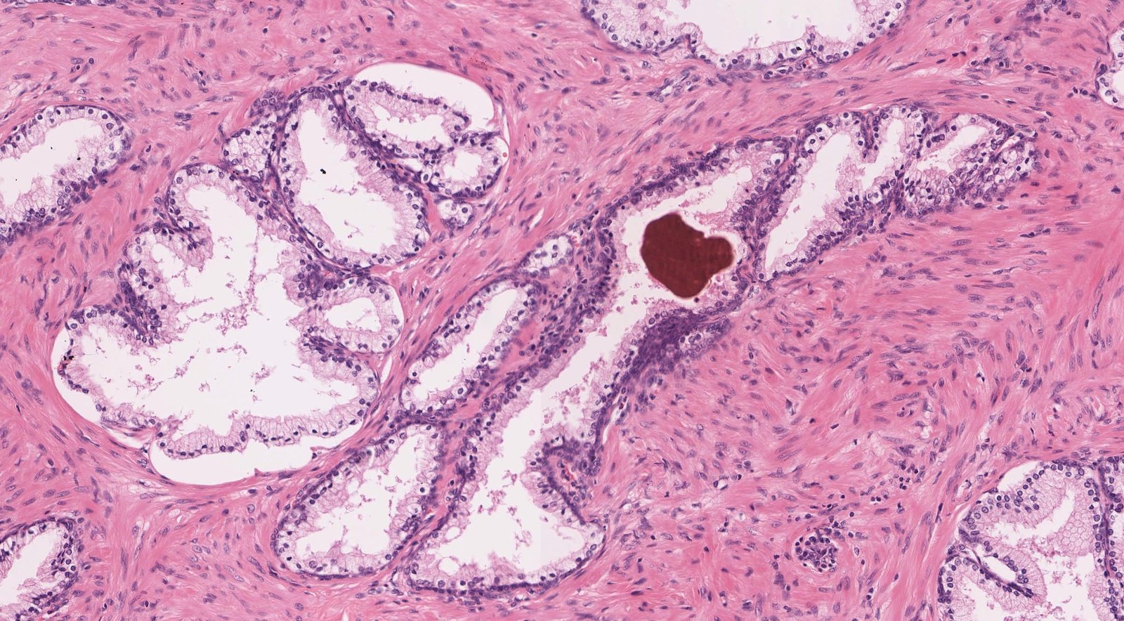 Prostate glands with corpus amylacea