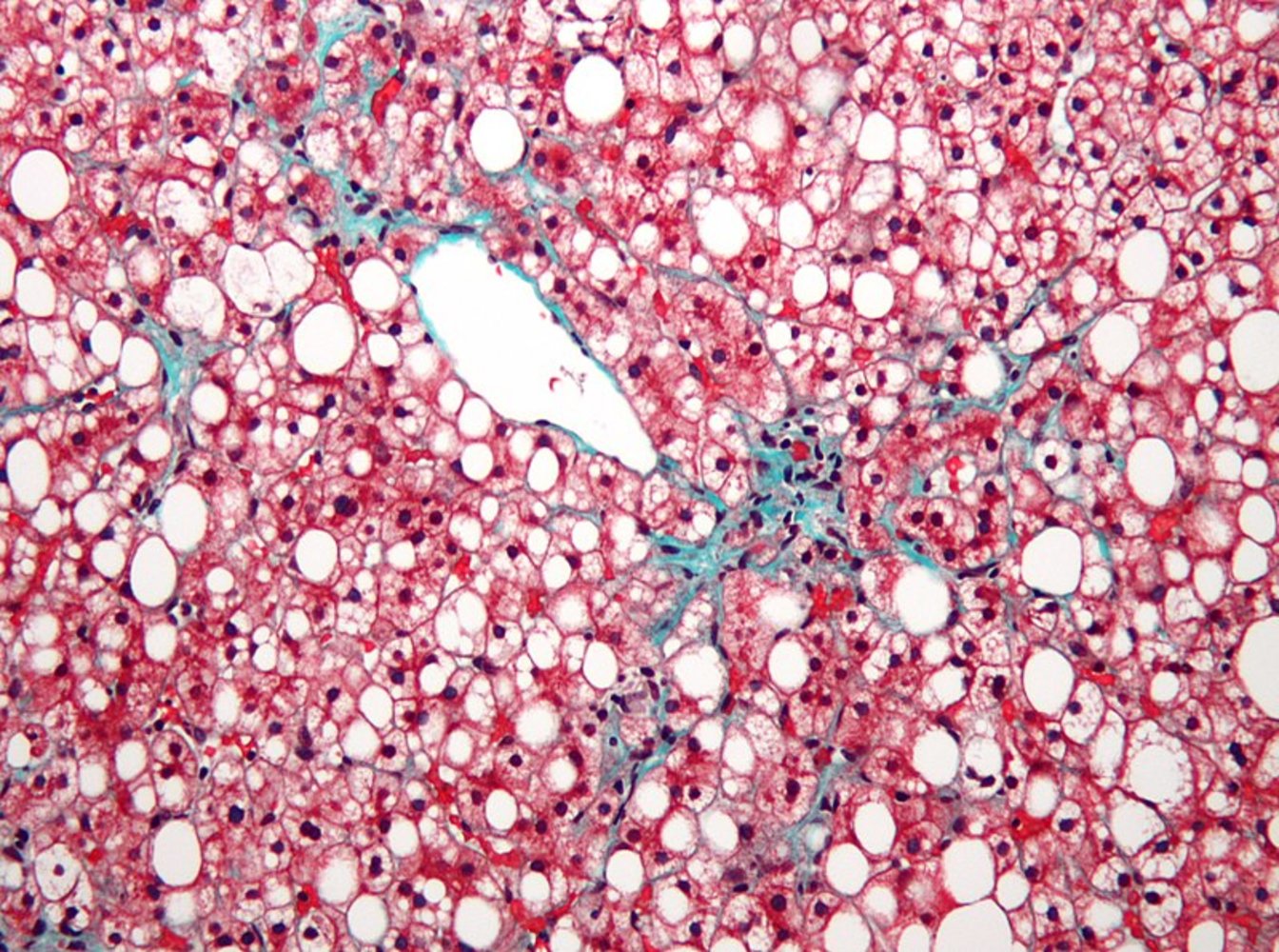 Metabolic dysfunction-associated steatotic liver disease (MASLD)