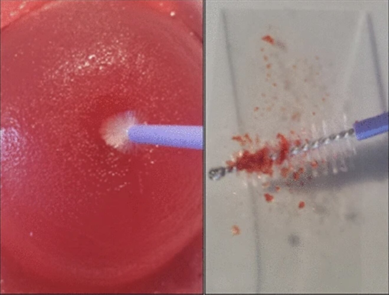 Endocervical brush (cytobrush)