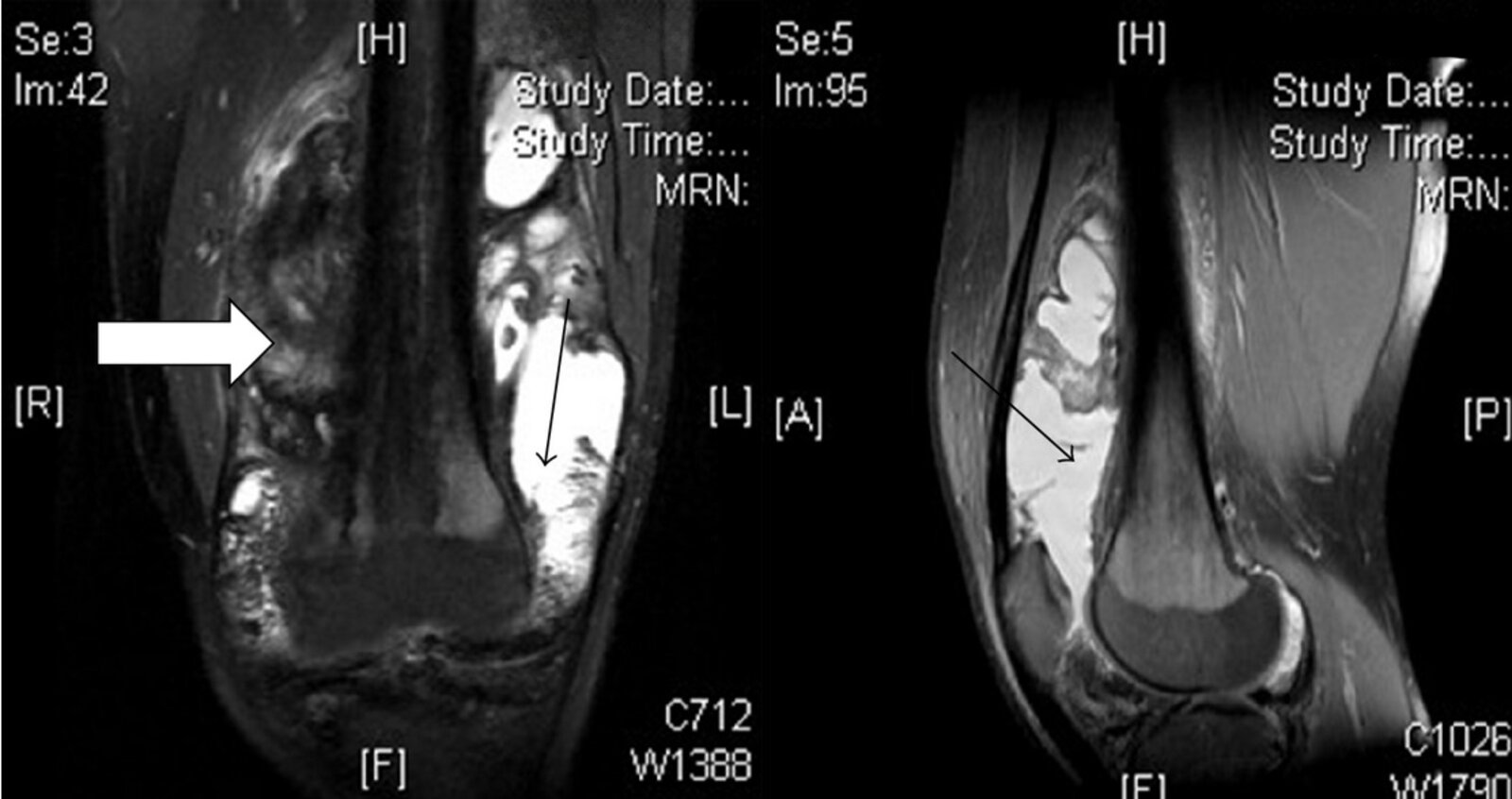 Hemarthrosis in hemophilia