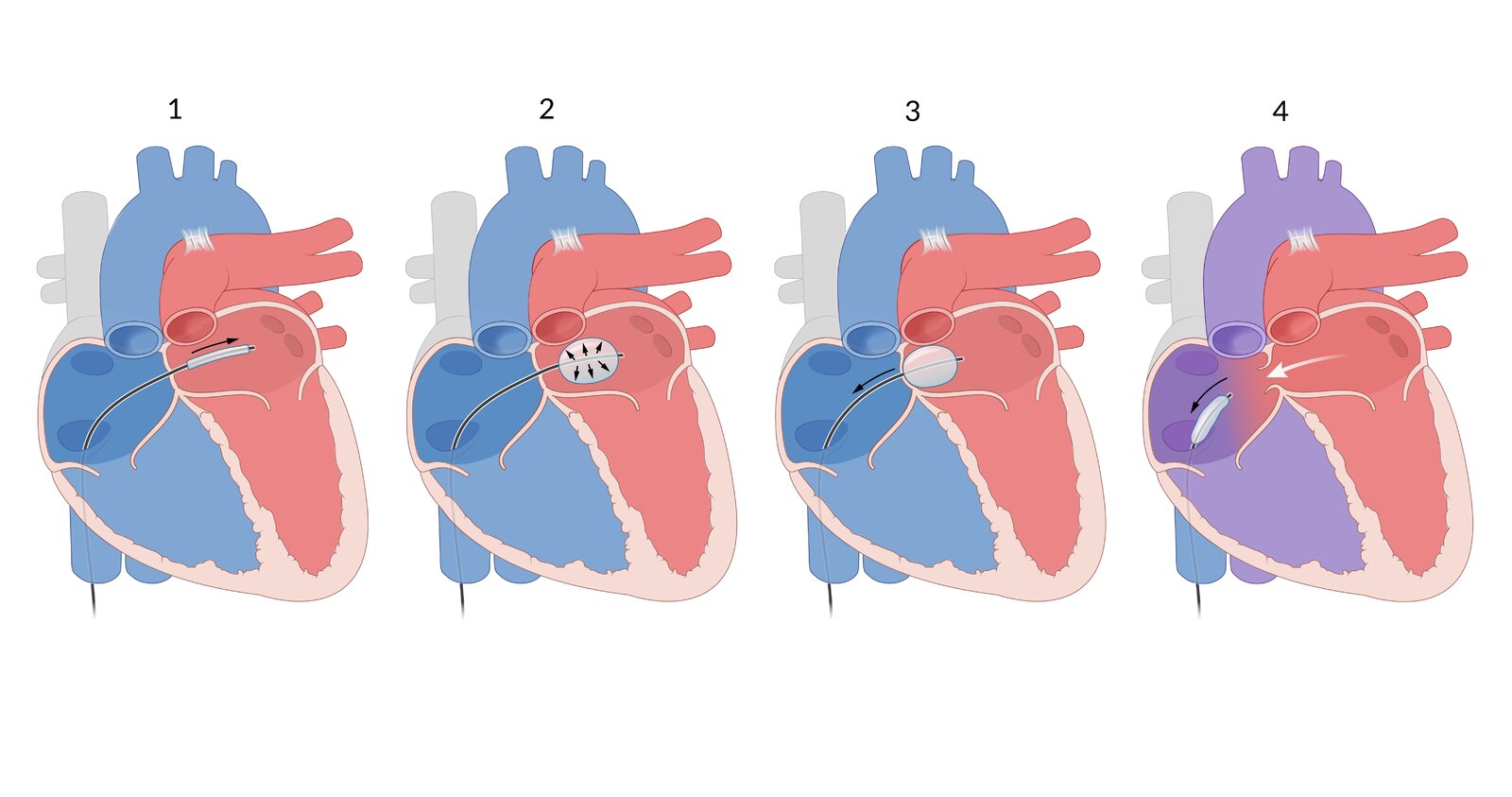Balloon atrial septostomy