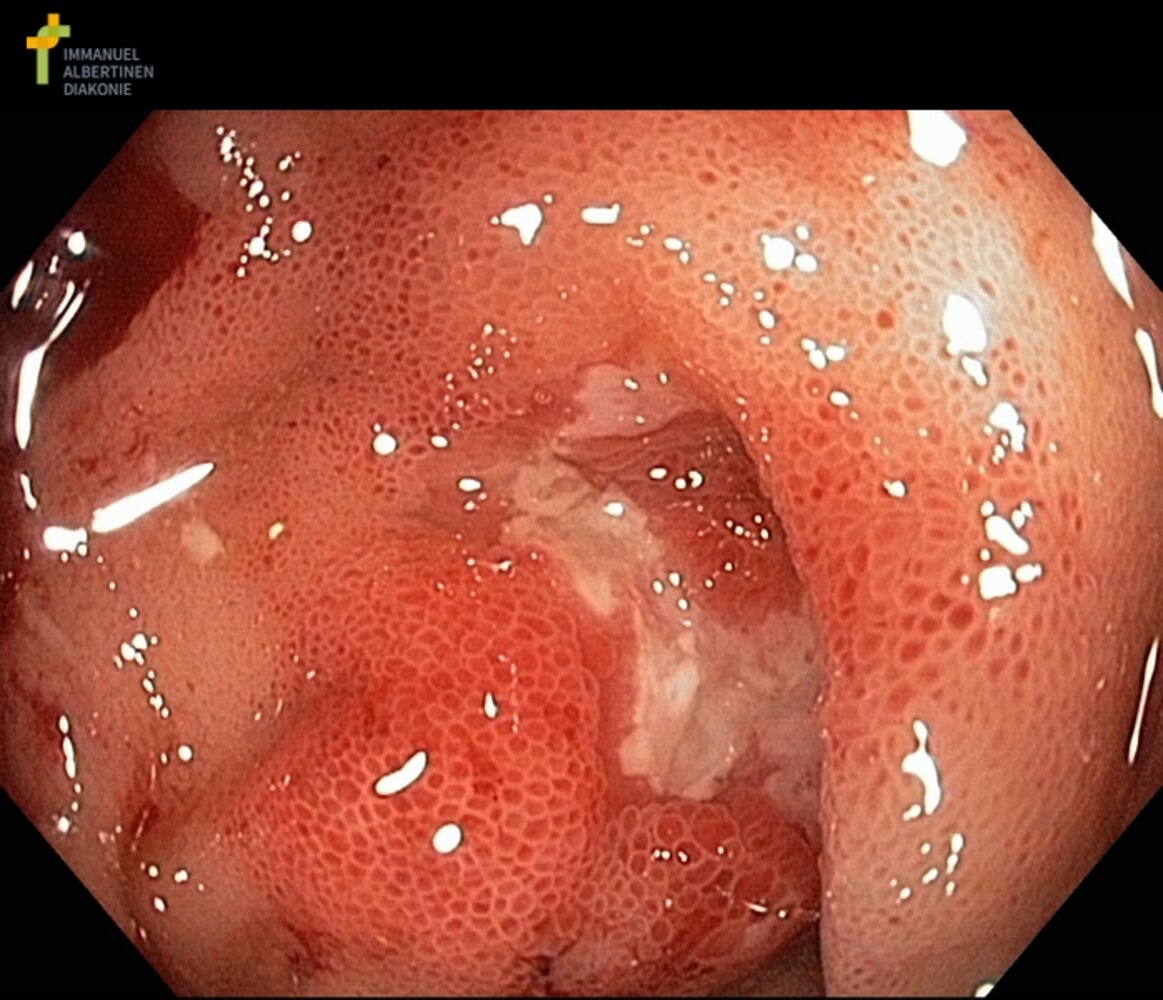 Terminal ileum in Crohn disease