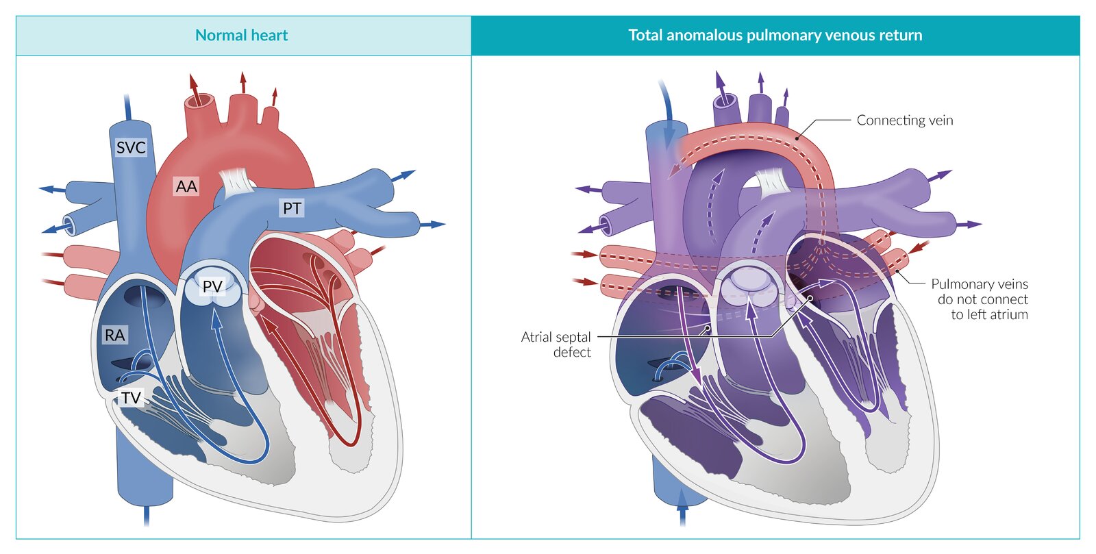 Total anomalous pulmonary venous return