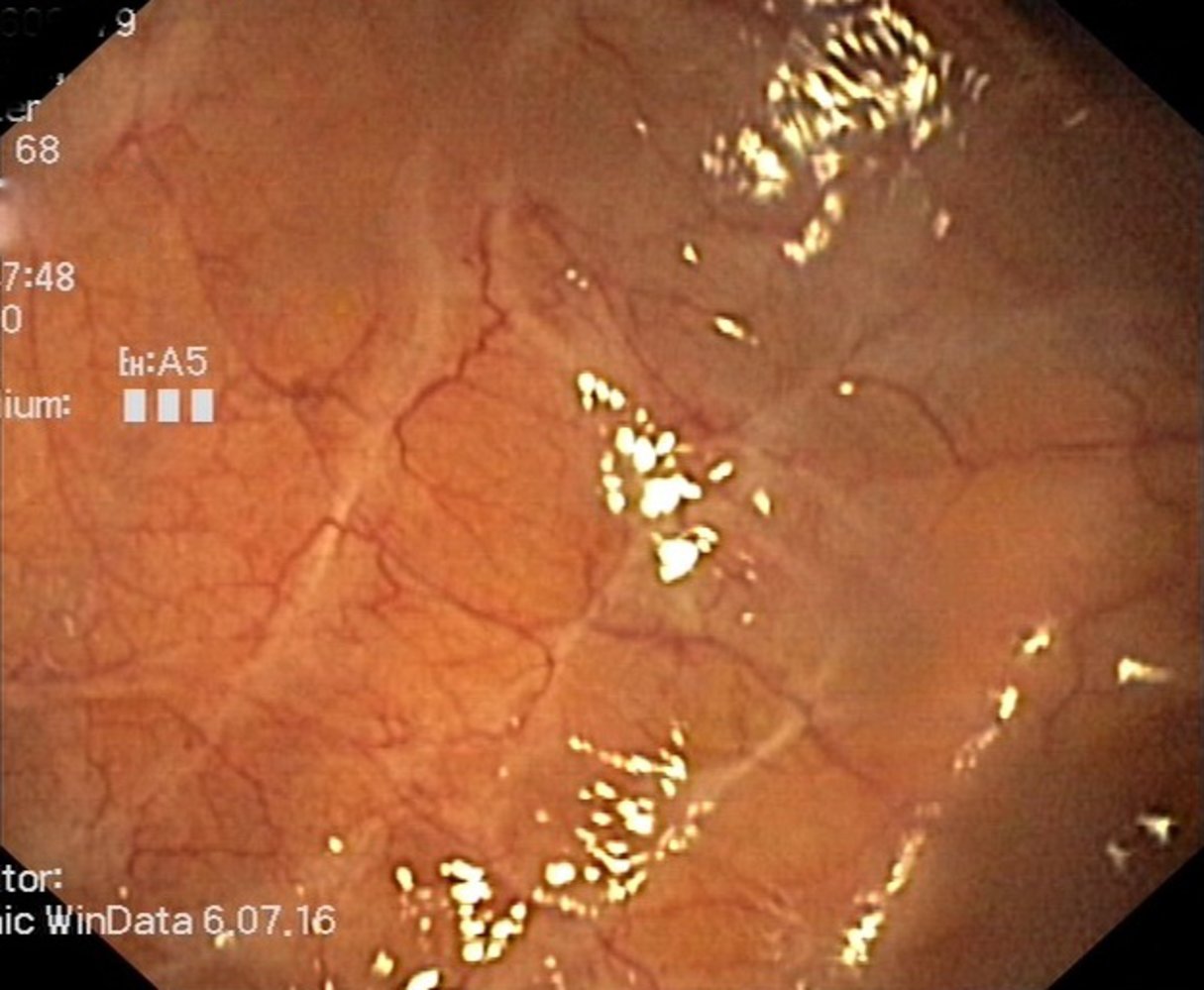 Ulcerative colitis in remission