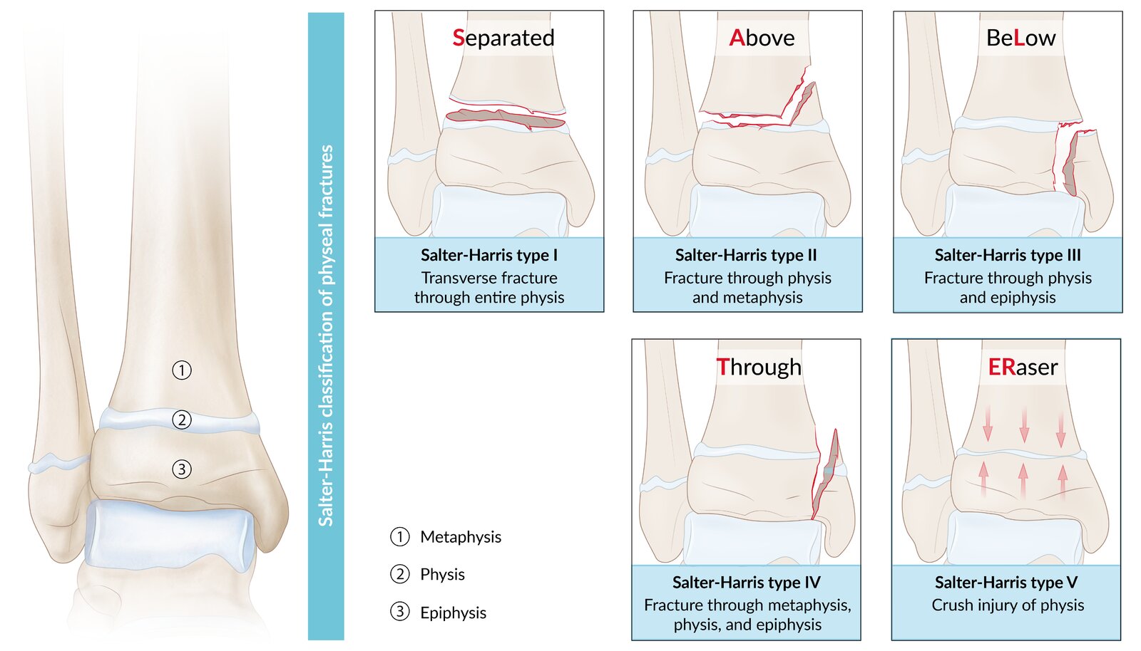 Salter-Harris fracture classification
