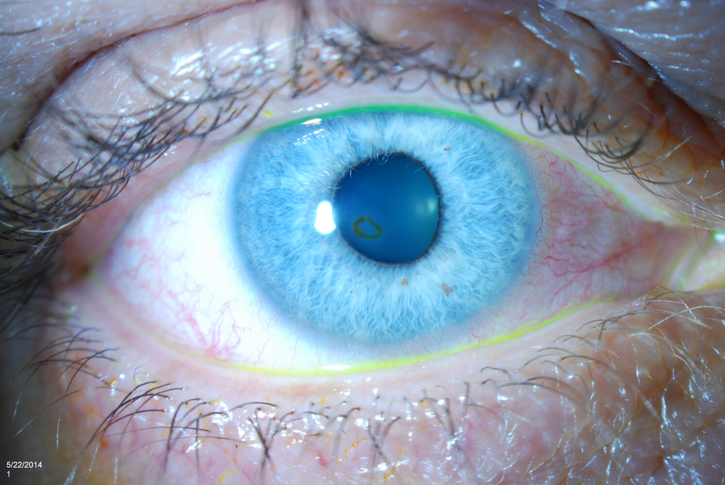 Corneal rust ring