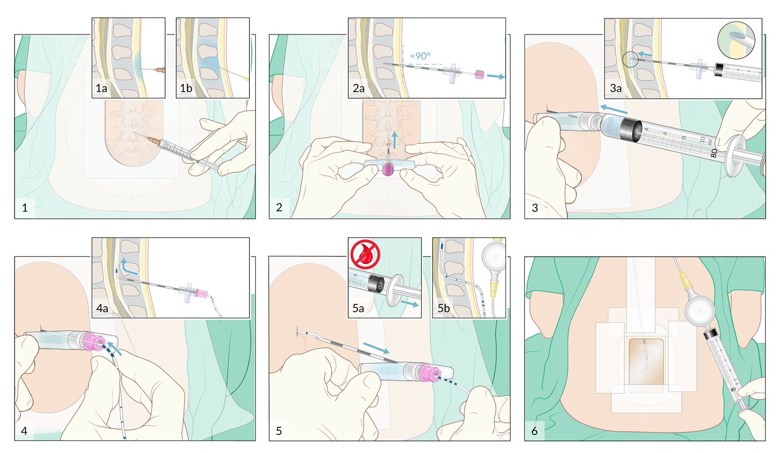Epidural anesthesia (2/2): procedure