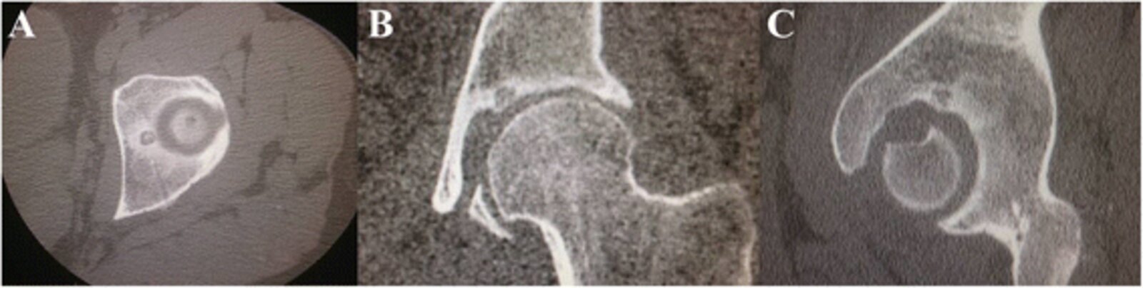 Osteoid osteoma of the acetabulum