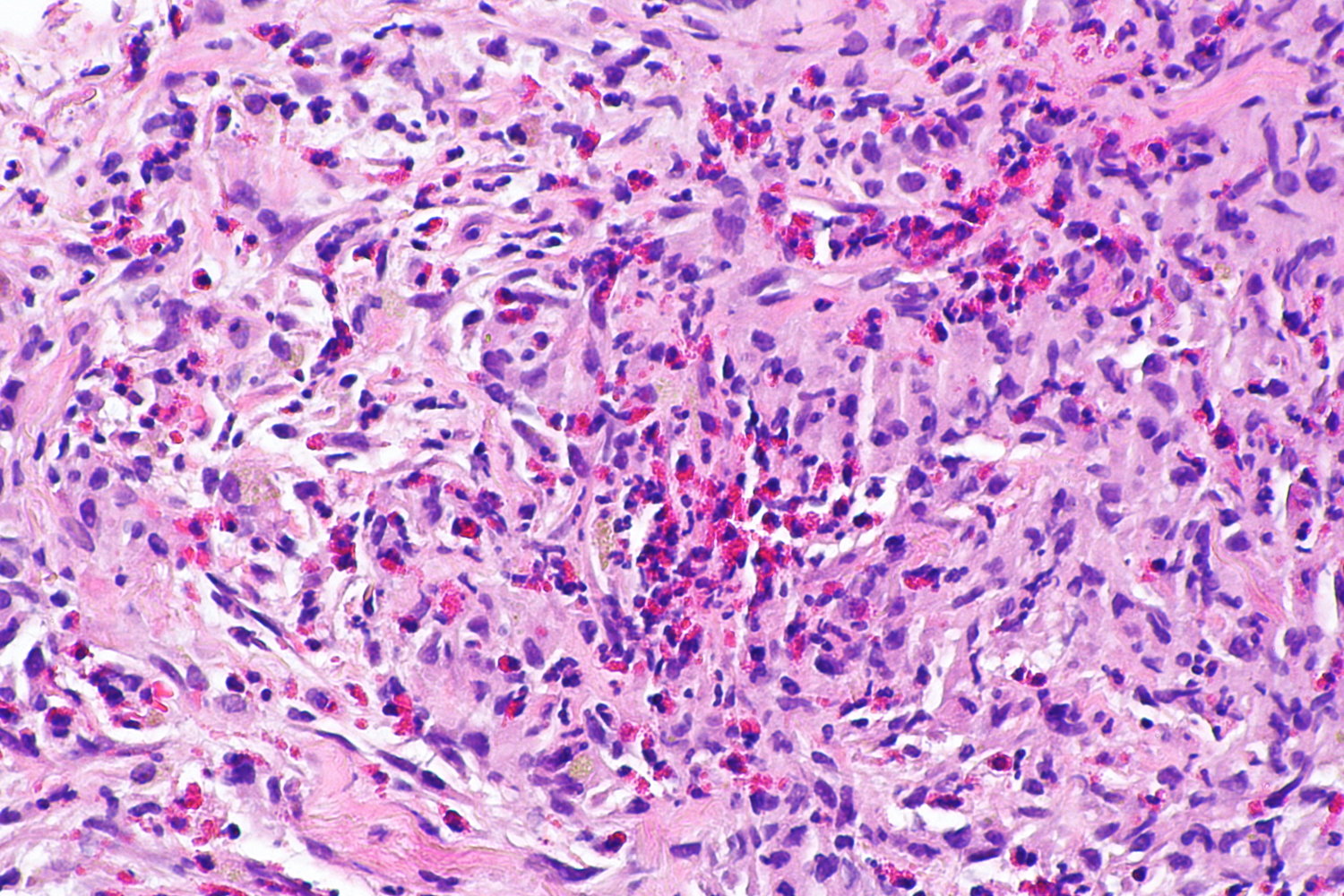 Langerhans cell histiocytosis (eosinophilic granuloma)