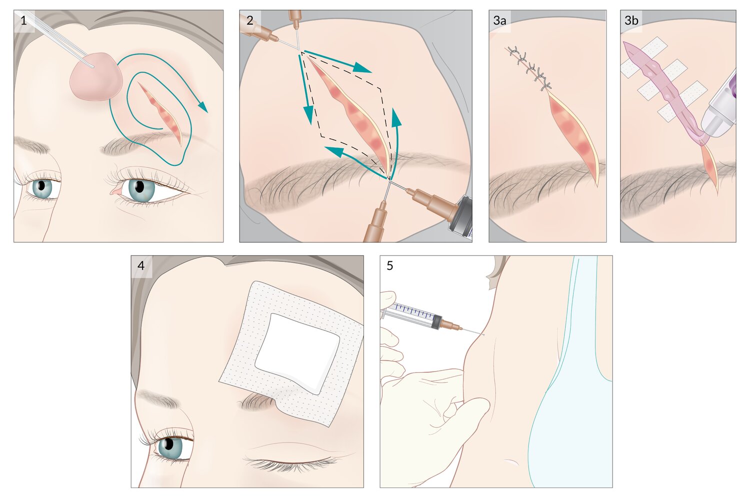 Acute wound management