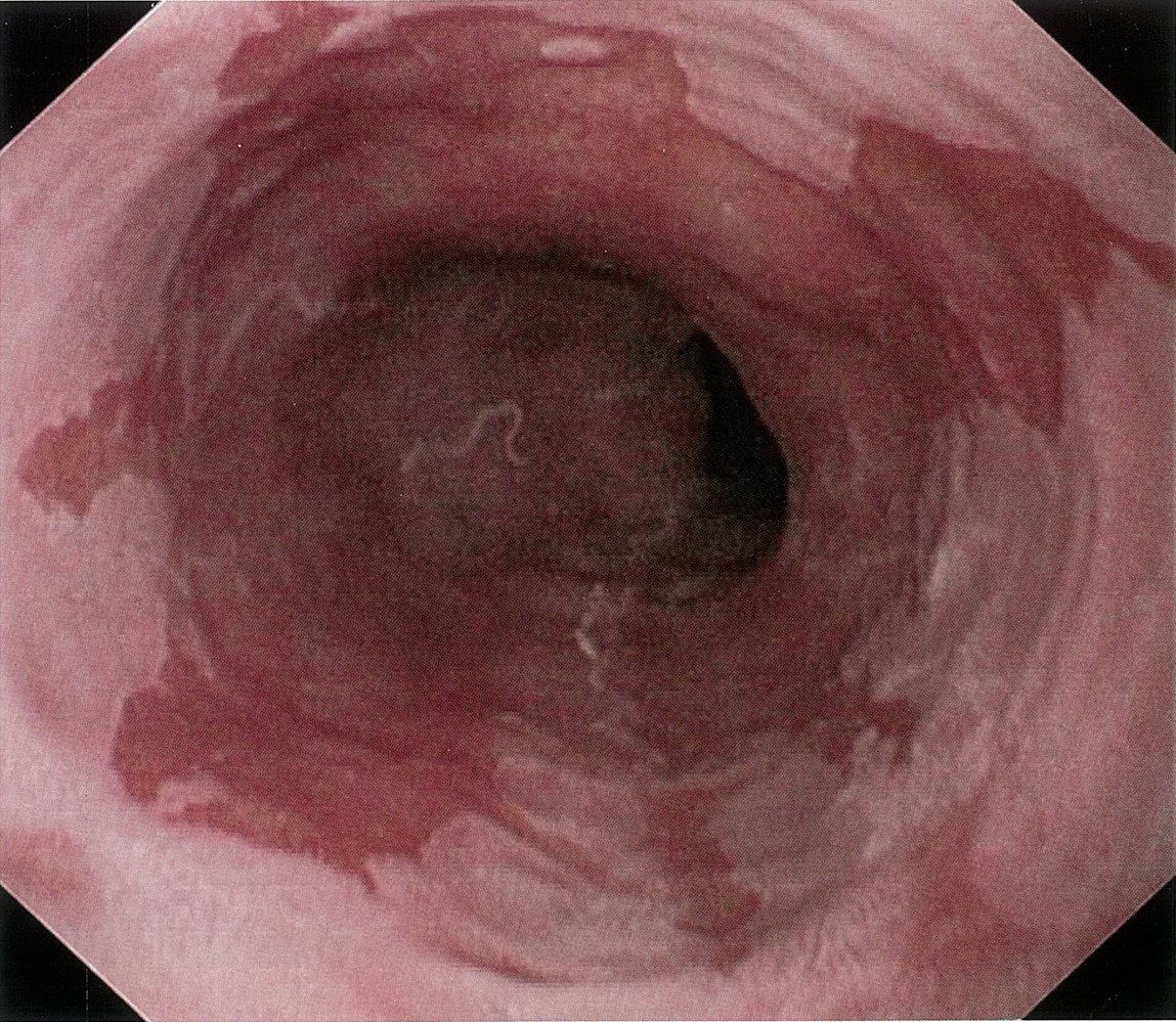 Barrett esophagus