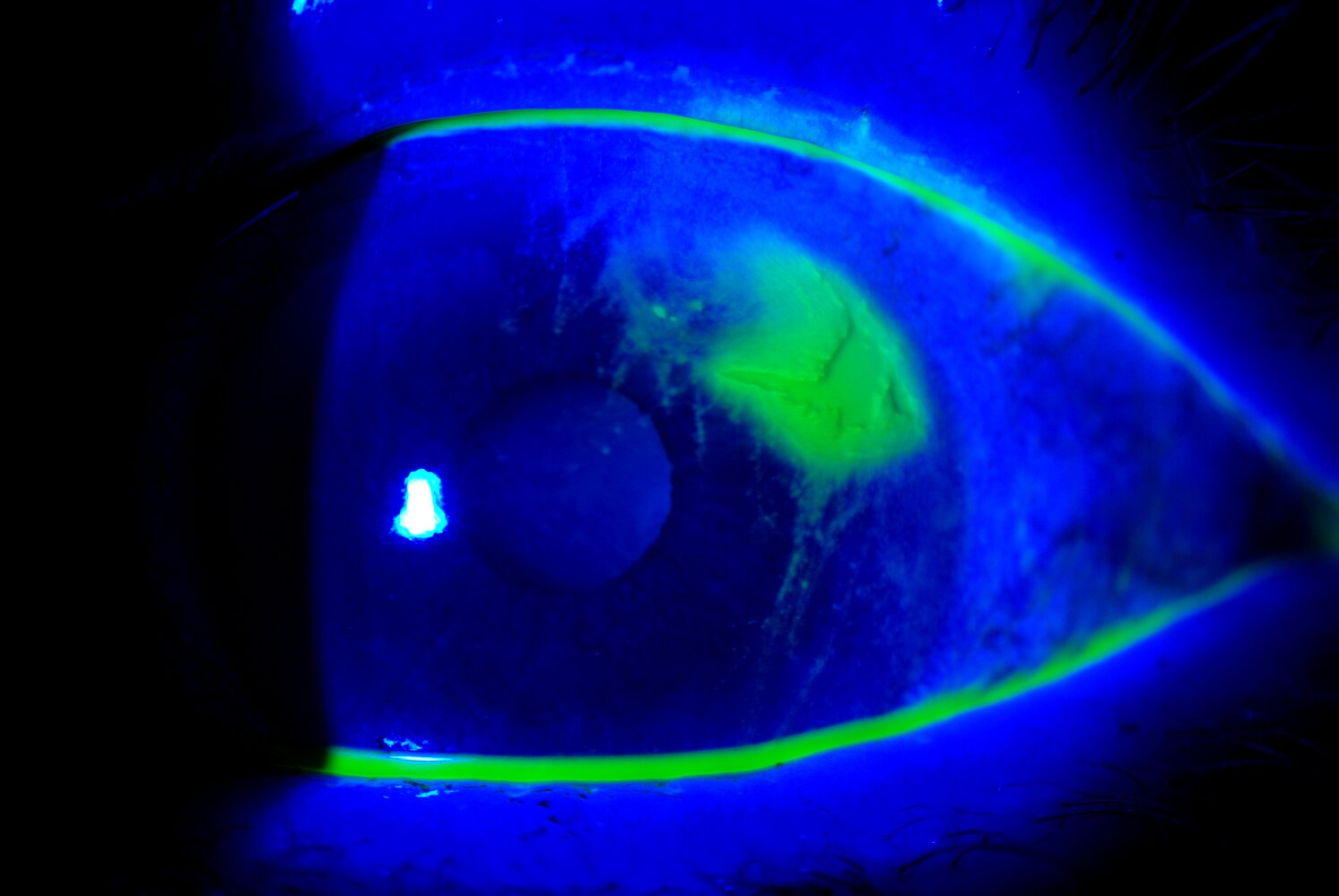 Corneal abrasion due to foreign body under the upper eyelid