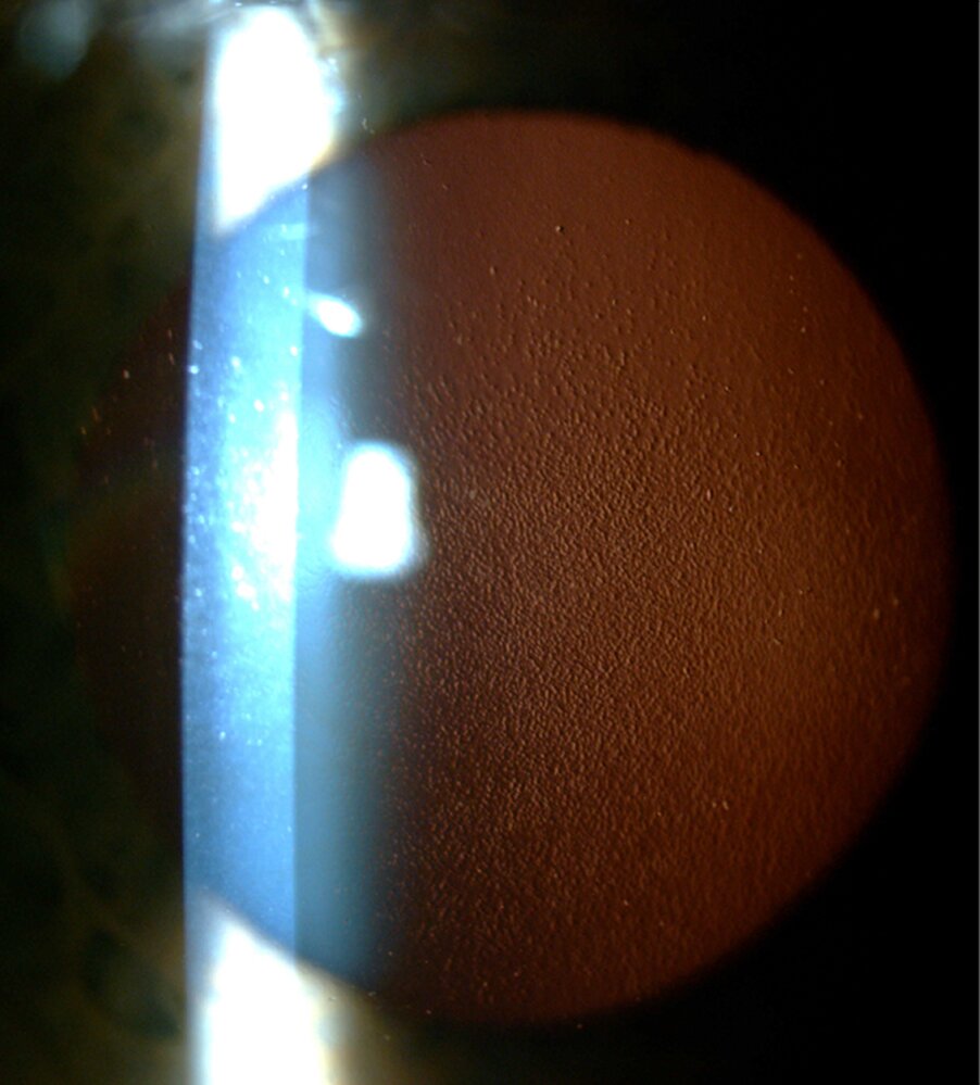 Cornea guttata