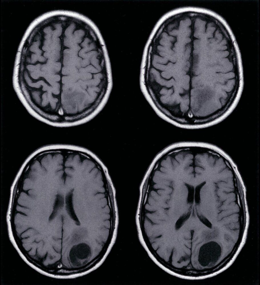 Cerebral metastasis in lung carcinoma 1/2