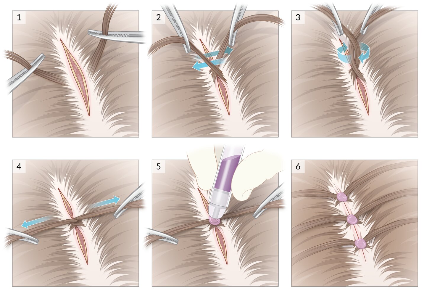 Hair apposition technique