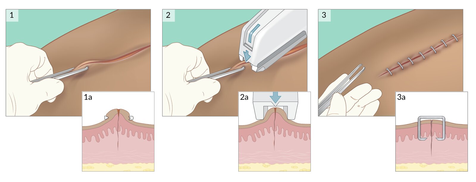 Tissue stapling