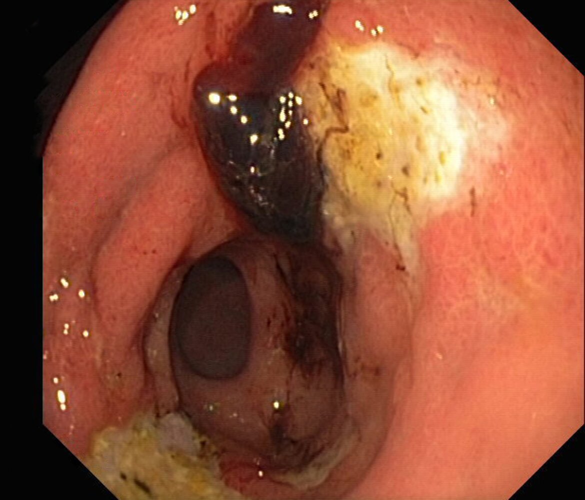 Duodenal ulcer: Forrest stage IIb