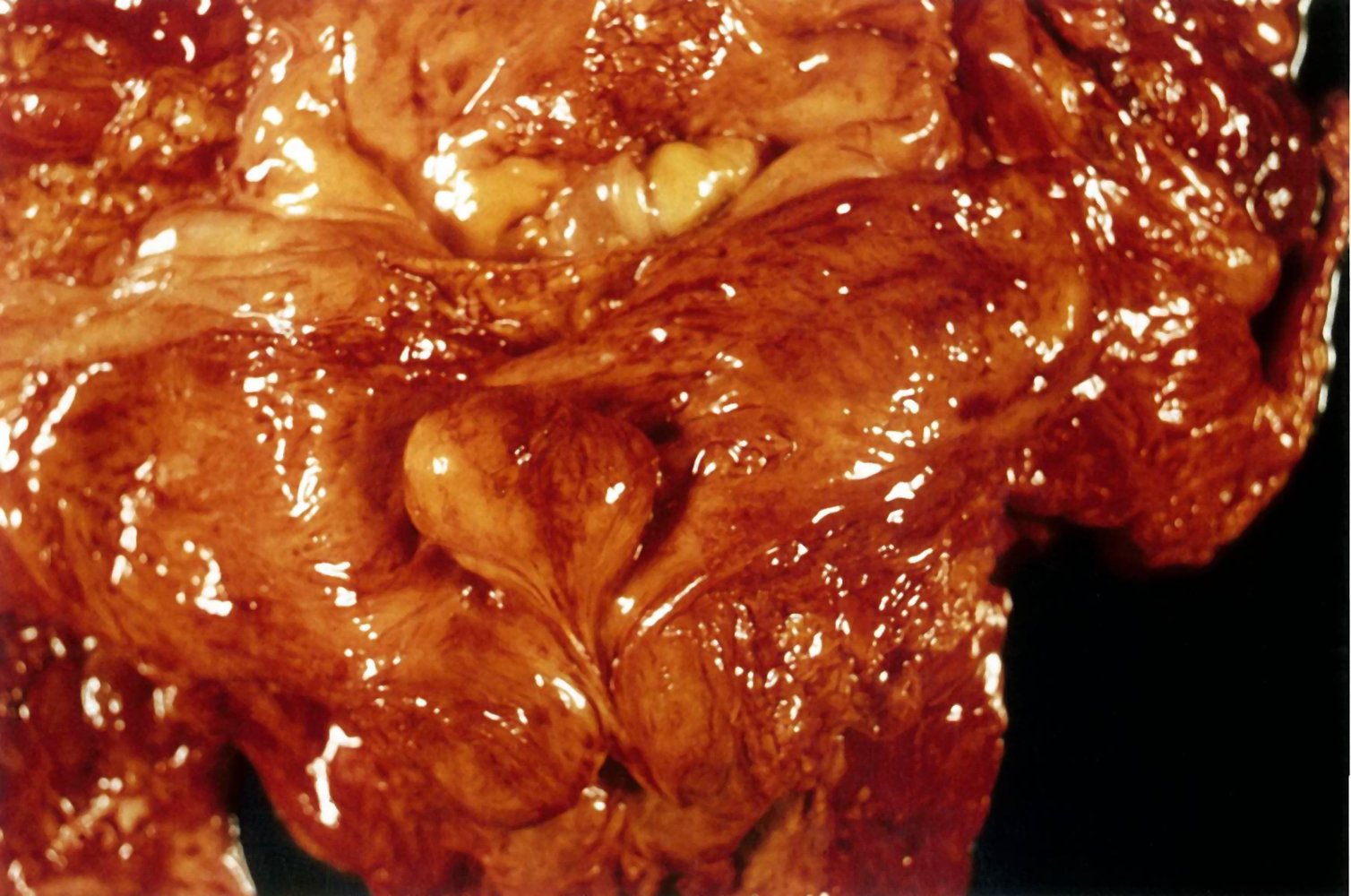 Middle lobe hyperplasia in prostate hyperplasia