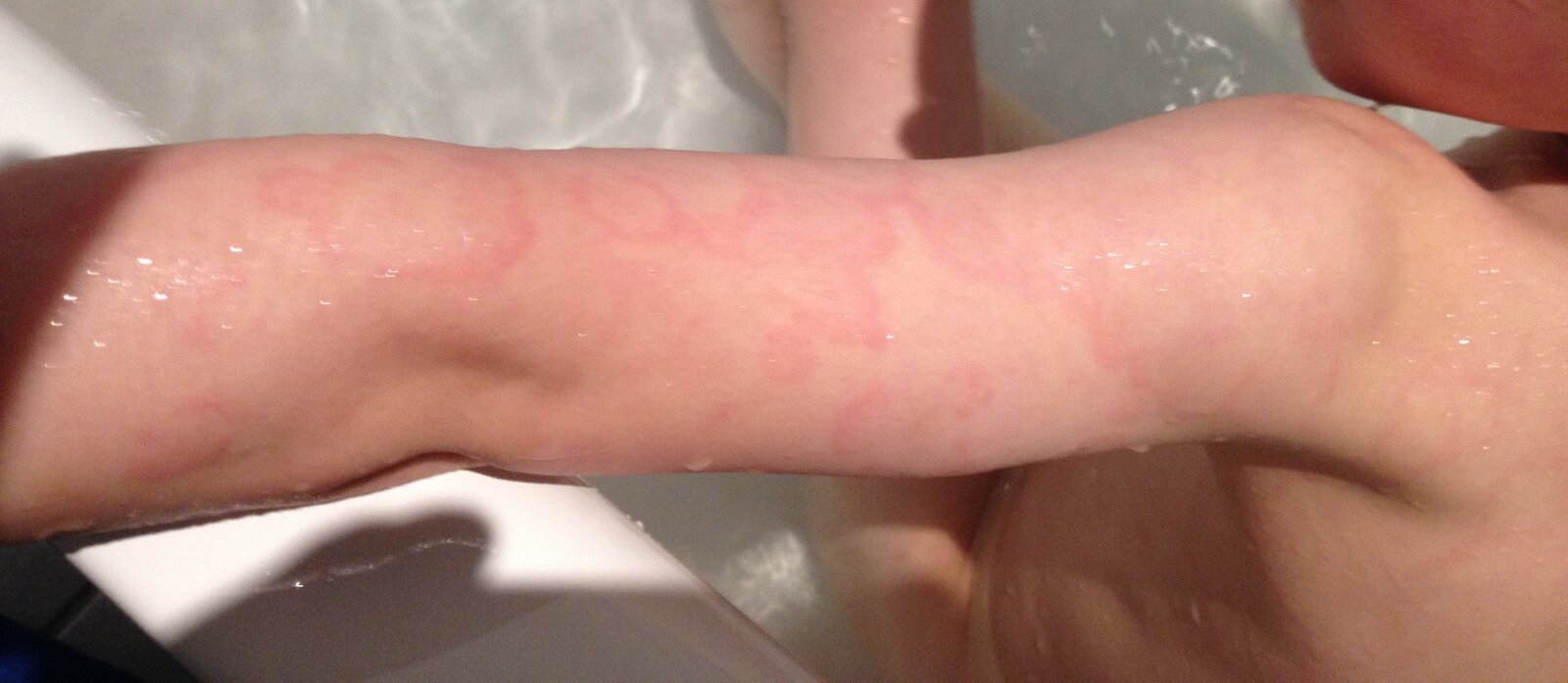 Erythema marginatum